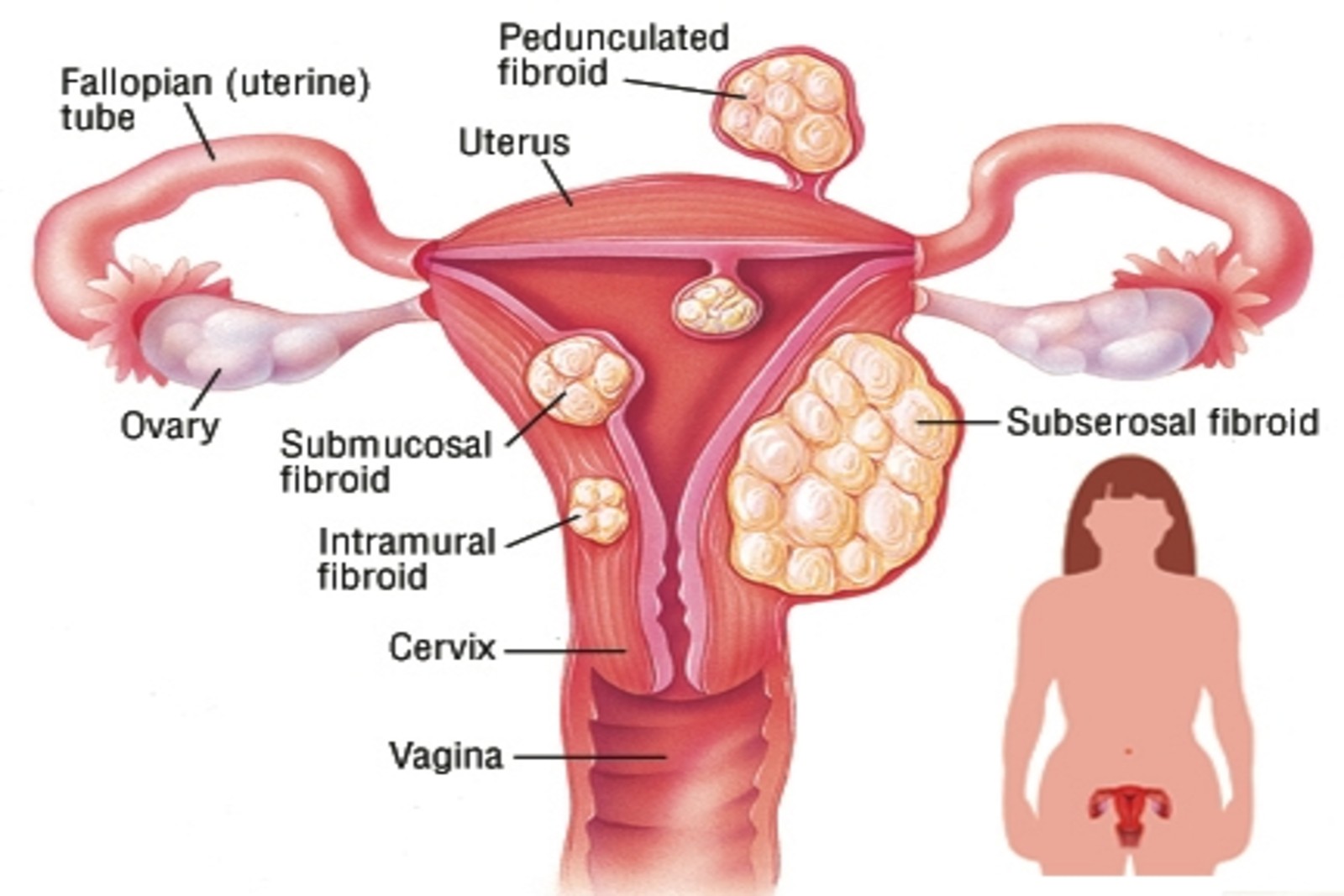 Fibroid