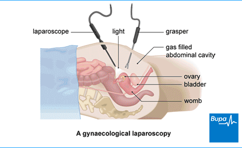 hysteroscopy